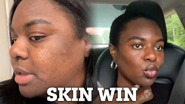 Woman Credits Ozempic for 6.5st Weight Loss and Unexpected Skin Benefits