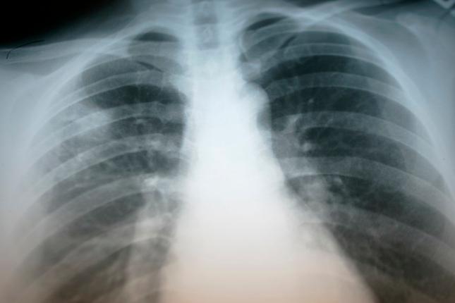 Marin County Sees 44% Increase in Tuberculosis Cases, Prompting Health Advisory
