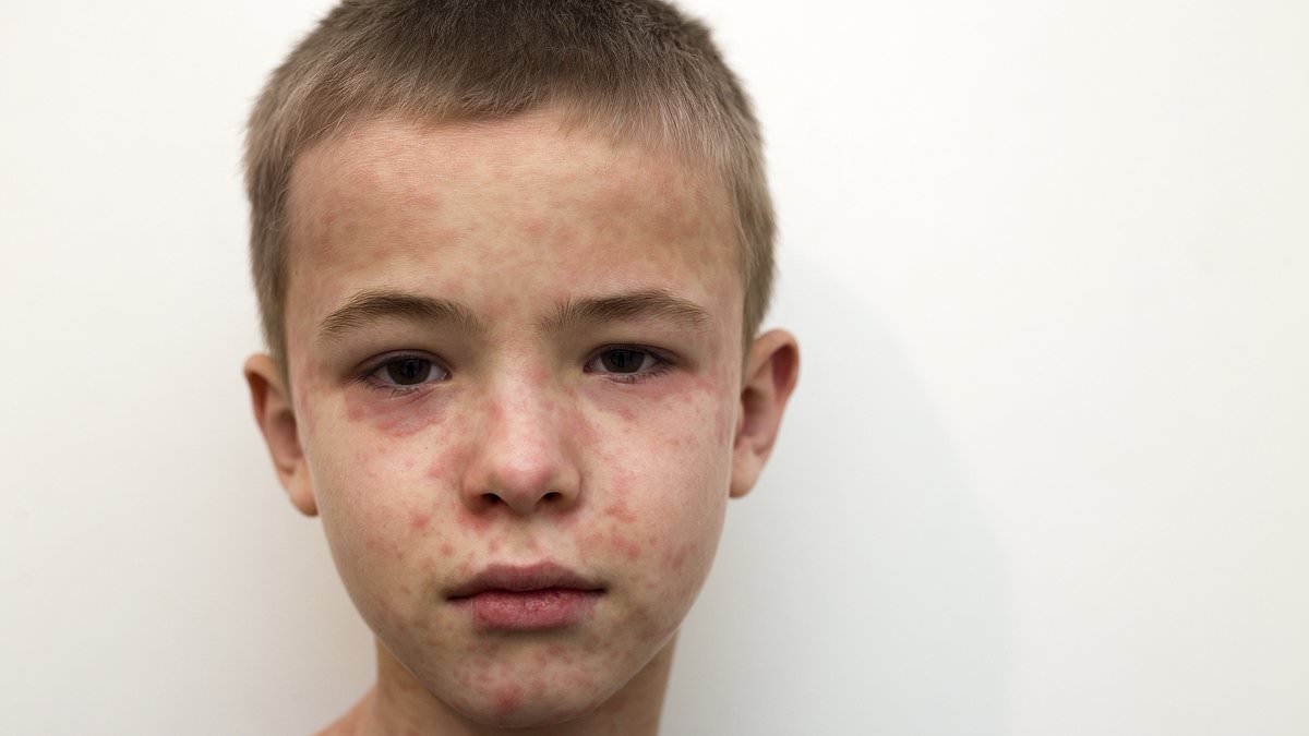 Measles Alert: St. Louis Officials Prepare for Potential Outbreak After Exposure