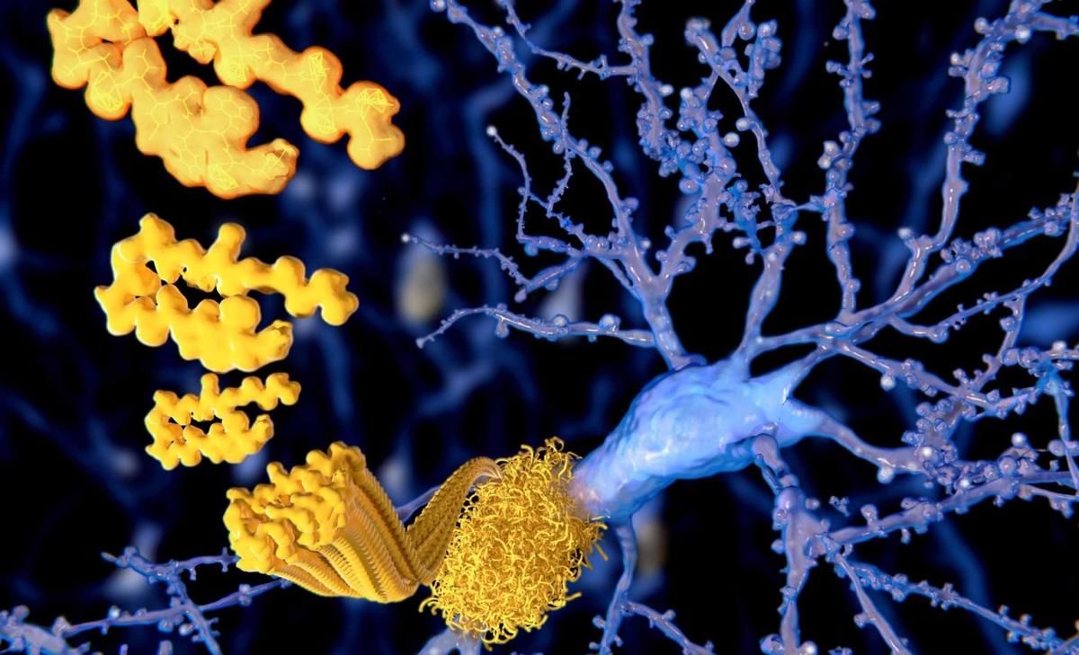 Teenage Boy, 17, Sets Record as Youngest Documented Alzheimer's Case
