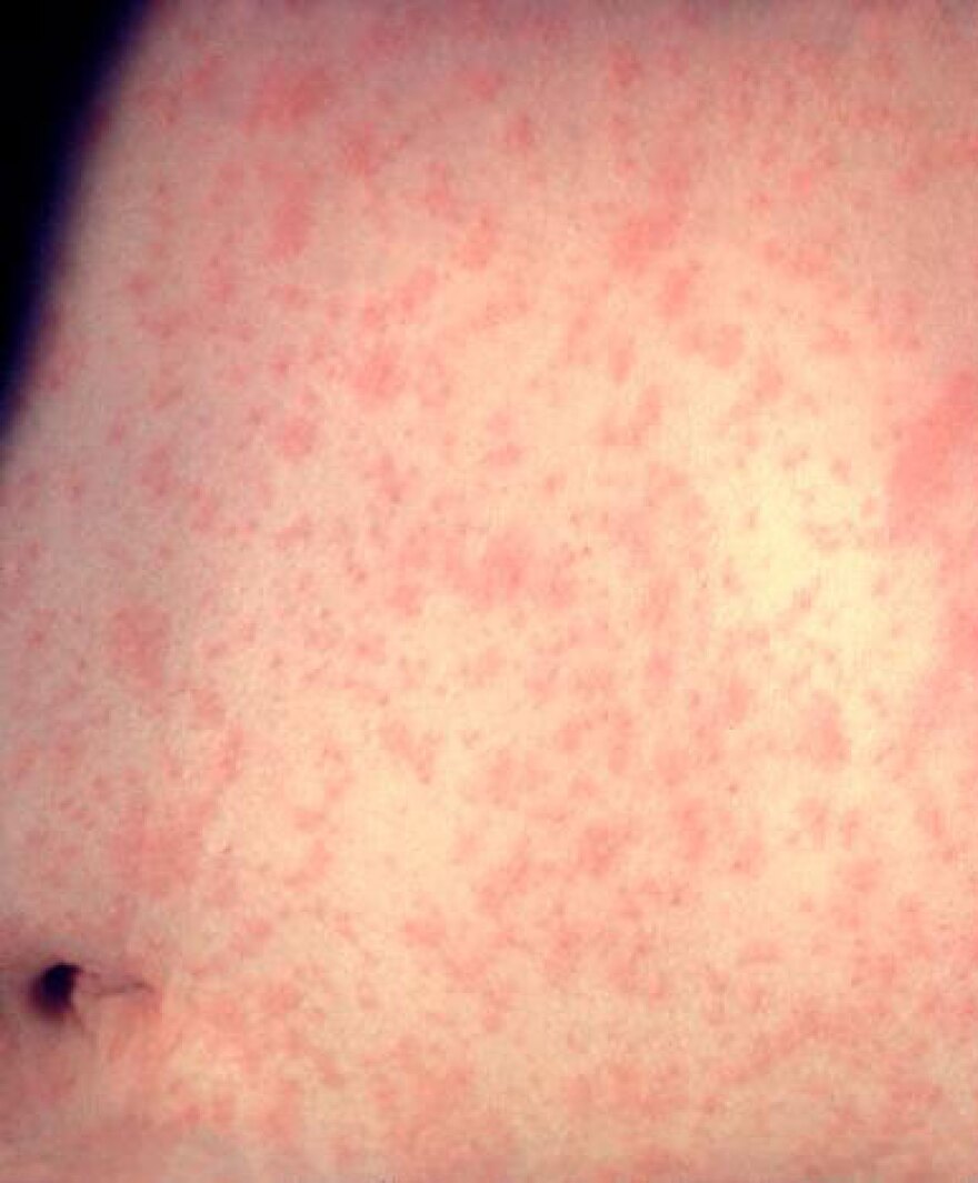Measles Outbreak in North Dakota: Nine Cases Confirmed, Isolation Measures Implemented