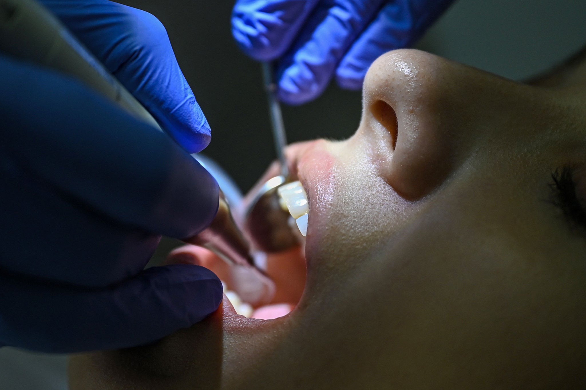 Ozempic Side Effects: Teeth Issues, Emotional Distress, and Emergency Room Visits