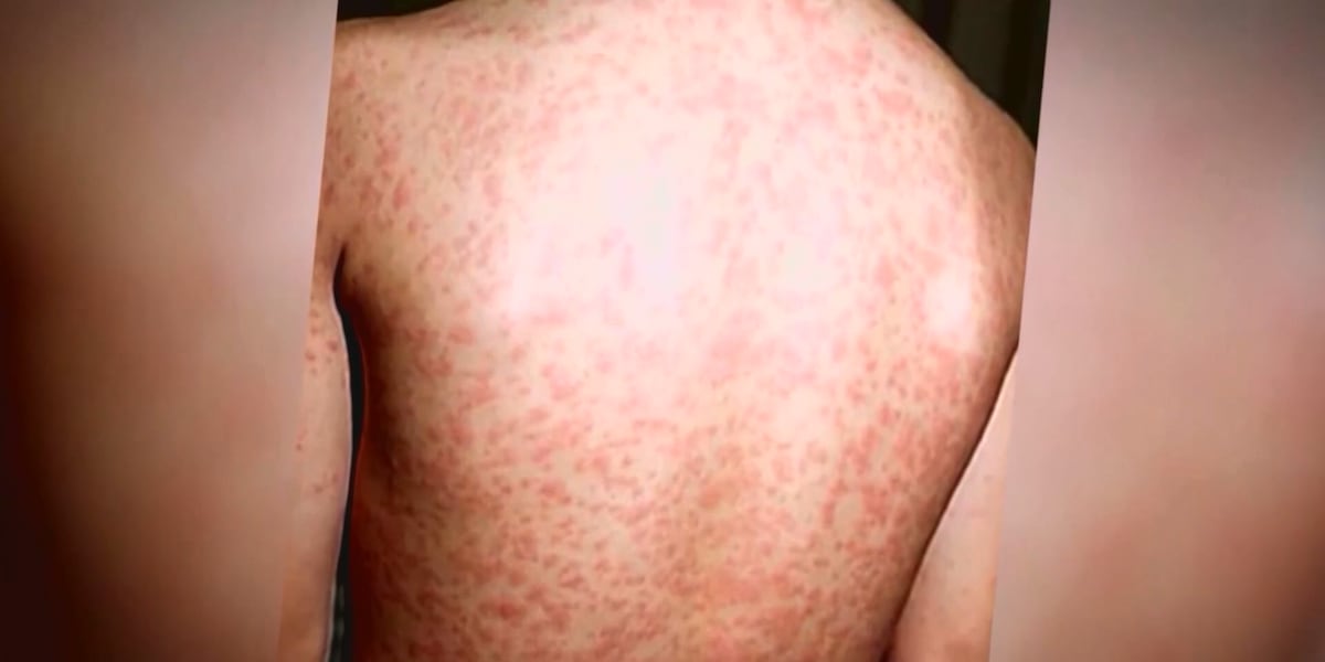 Measles Outbreak in Kansas: Cases Rise, Vaccination Urged, Exposure Site Identified